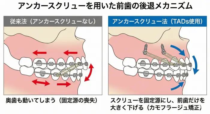 歯科矯正用アンカースクリュー（TADs）を用いることで、奥歯を固定源とし、前歯を最大限後退させるカモフラージュ矯正のメカニズム。